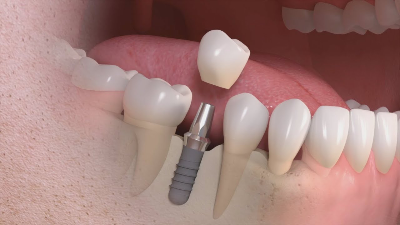 Qué es un implante dental y sus fases?, Blog
